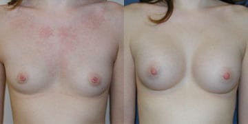 Before-Breast Augmentation