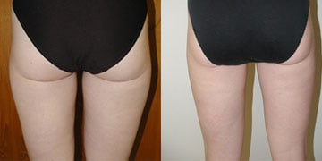 Before-Liposuction