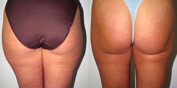 After-Liposuction