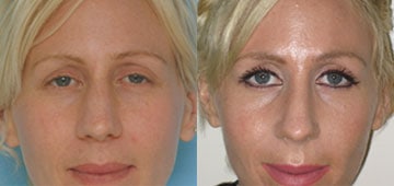 Before-Rhinoplasty