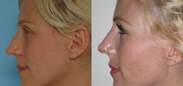 After-Rhinoplasty