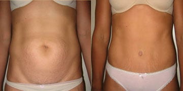 Before-Tummy Tuck